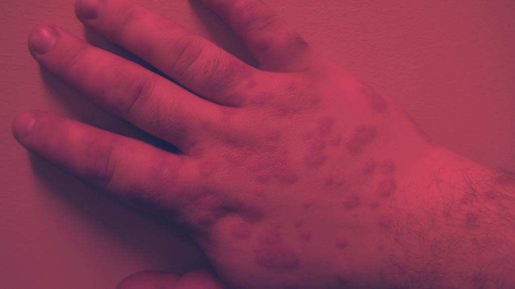 Red Light Therapy for Erythema