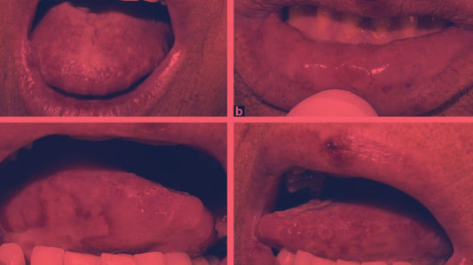 Red Light Therapy for Mucositis