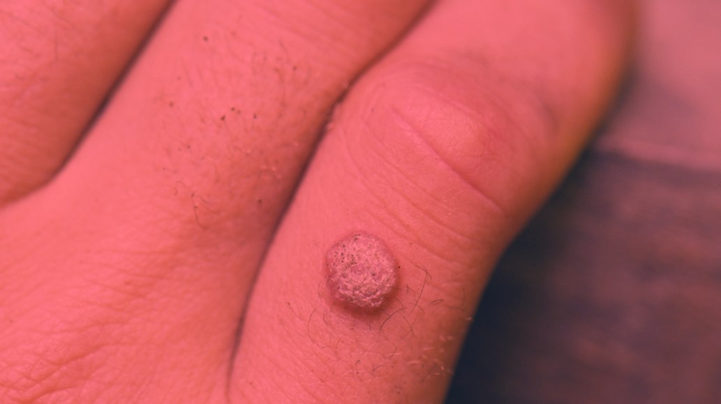 Red Light Therapy for Warts