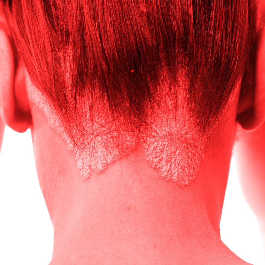 Effective Red Light Therapy for Psoriasis Treatment