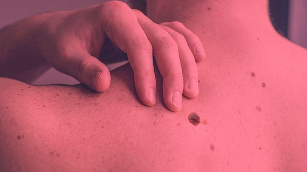 Can Red Light Therapy Cause Melanoma