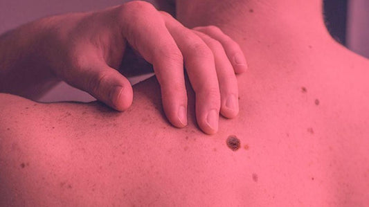 Can Red Light Therapy Cause Melanoma