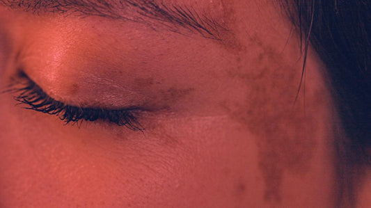 Does Infrared Light Cause Hyperpigmentation