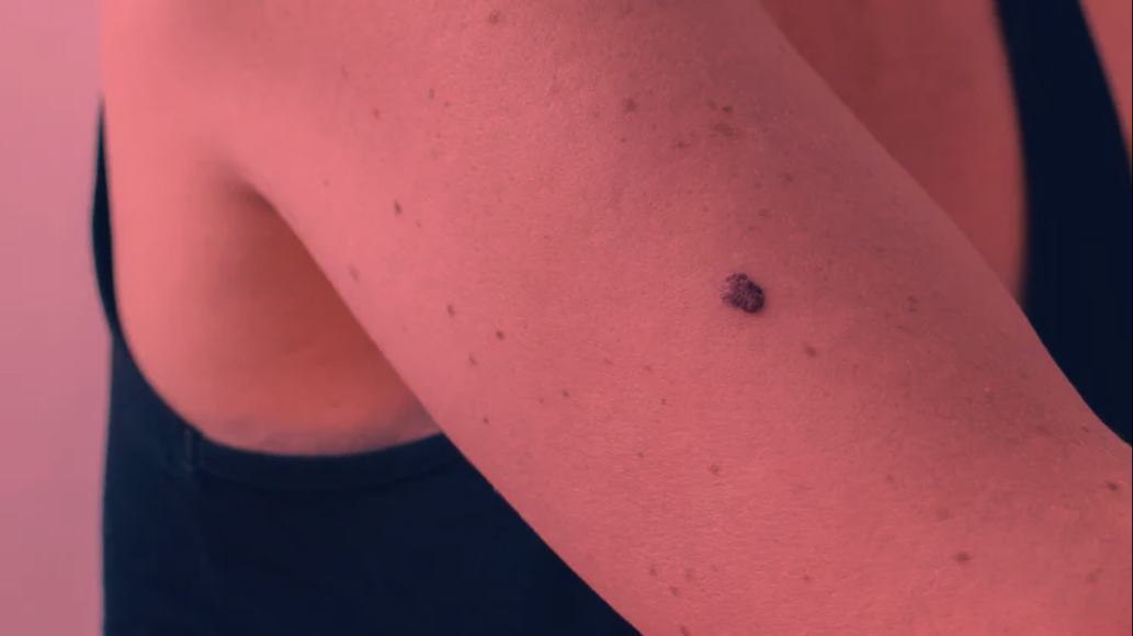 Does Infrared Light Cause Skin Cancer