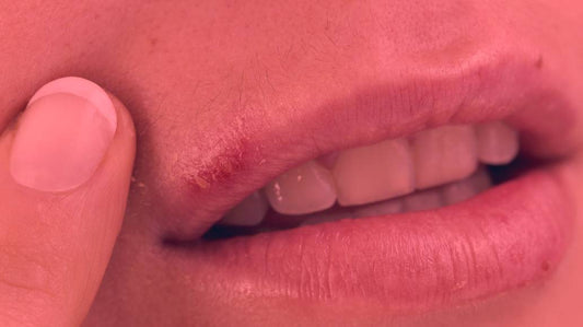 Red Light Therapy for Cold Sores