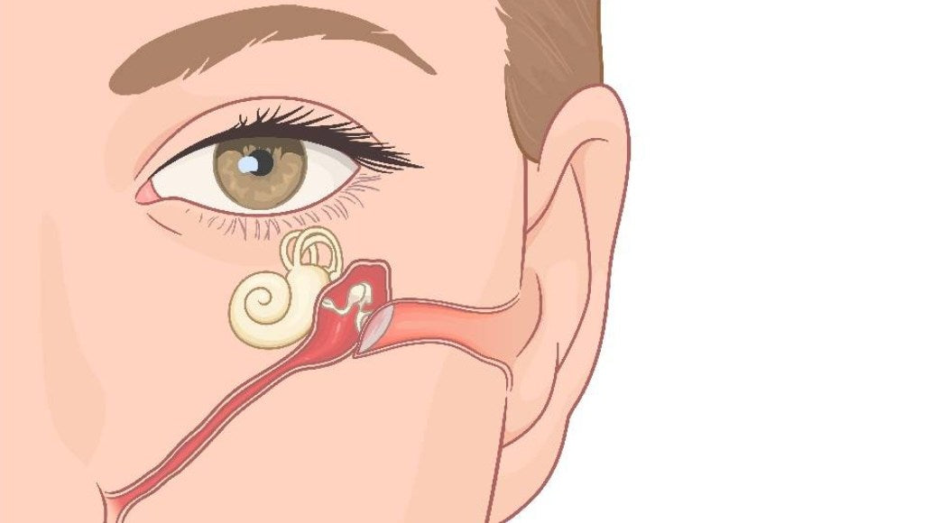 Red Light Therapy for Eustachian Tube Dysfunction
