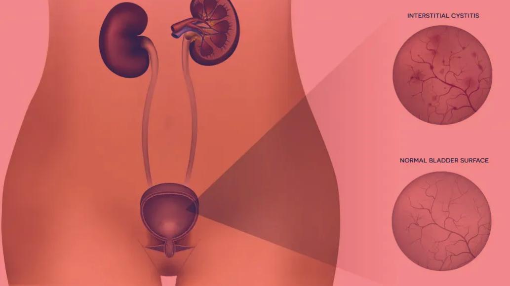 Red Light Therapy for Interstitial Cystitis