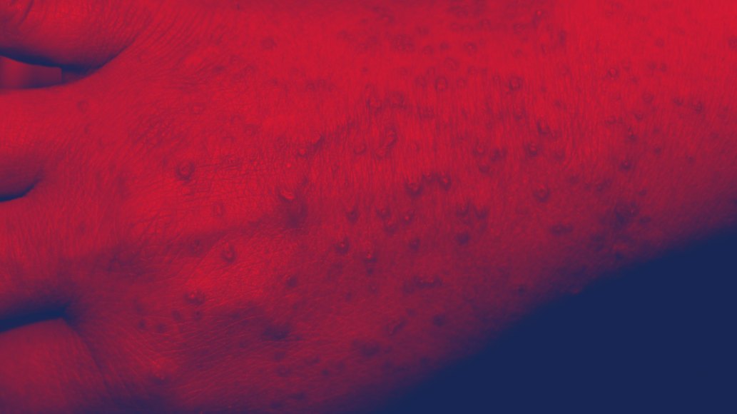 Red Light Therapy for Lichen Planus