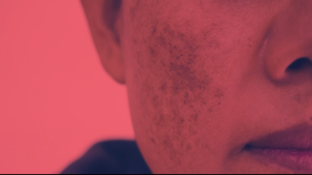 Red Light Therapy for Melasma