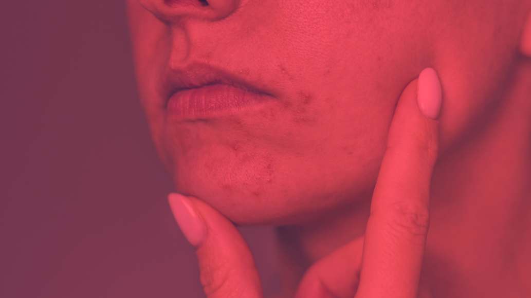 Red Light Therapy for Perioral Dermatitis