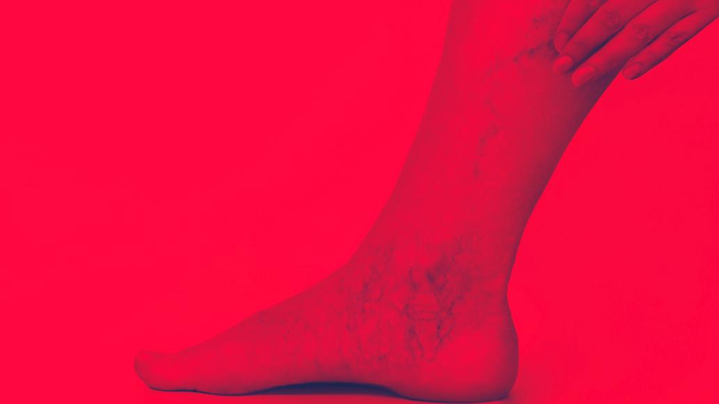 Red Light Therapy for Spider Veins