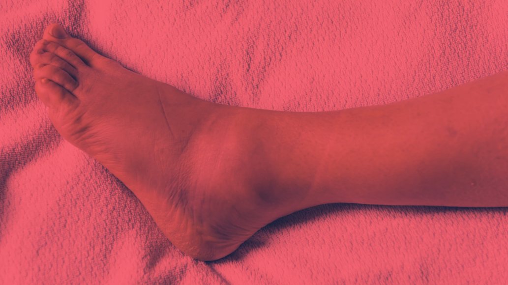 Red Light Therapy for Sprained Ankle