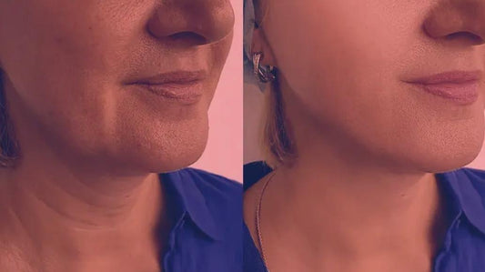 Red Light Therapy for Turkey Neck