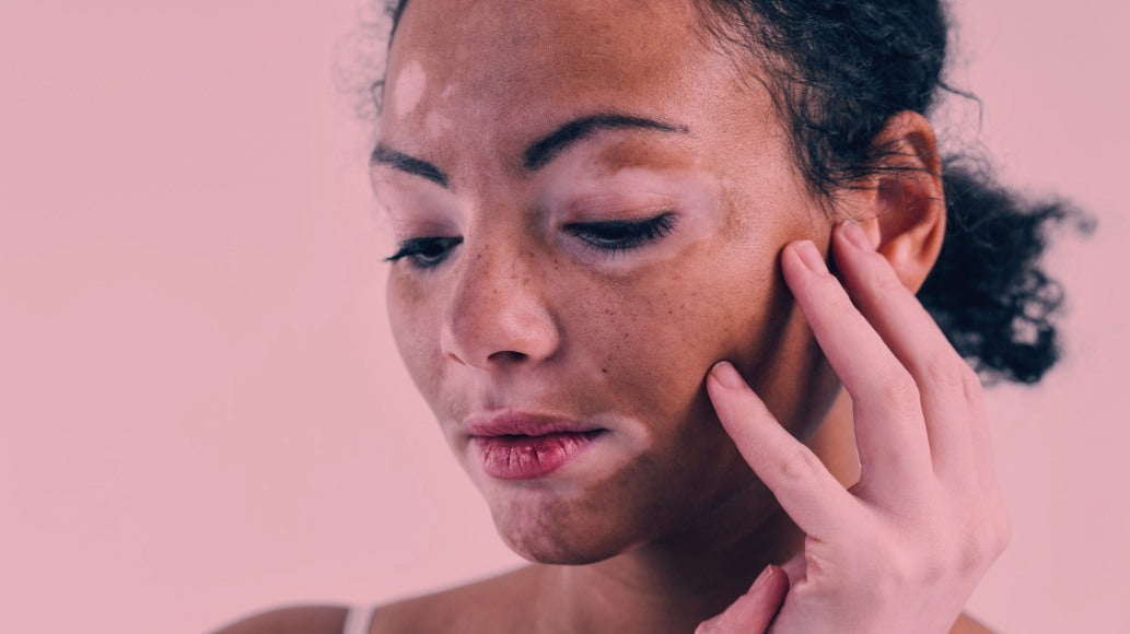 Red Light Therapy for Vitiligo