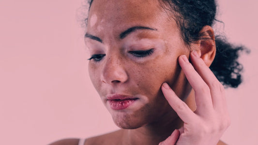 Red Light Therapy for Vitiligo