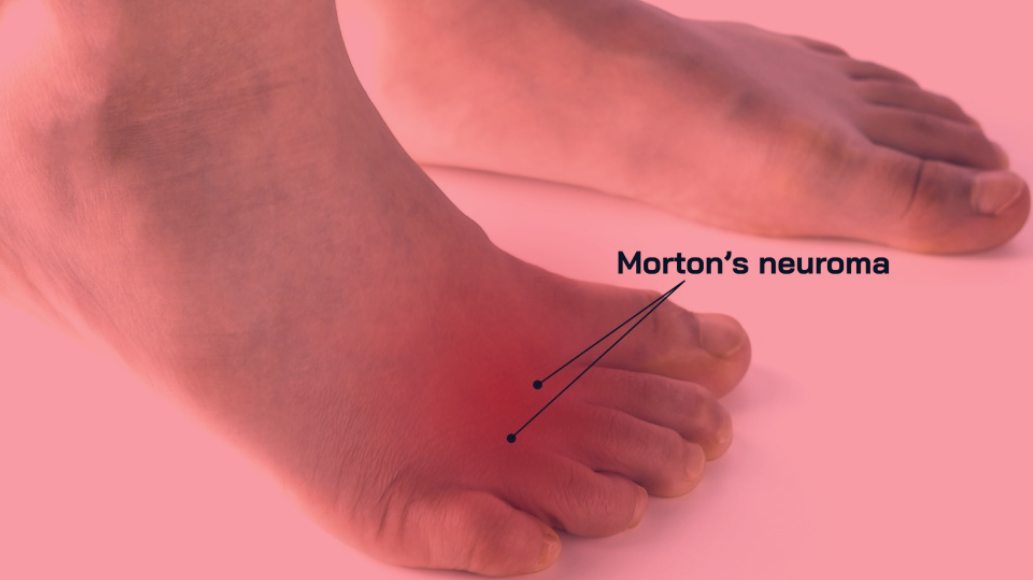 Red Light Therapy for Morton's Neuroma