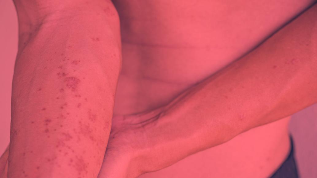 Red Light Therapy for Atopic Dermatitis