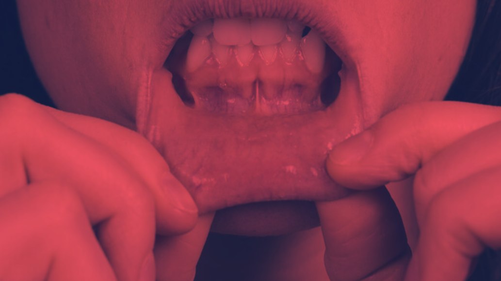 Red Light Therapy for Canker Sores - Relieve Pain