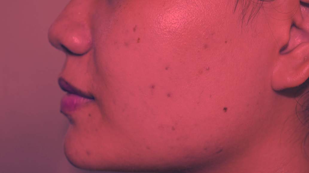 Red Light Therapy for Dark Spots