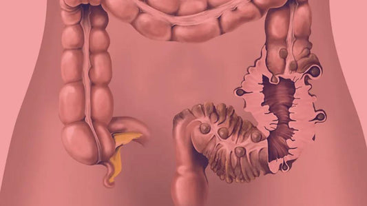 Red Light Therapy for Diverticulitis