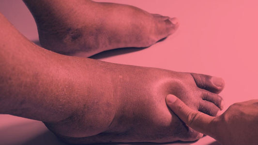 Red Light Therapy for Edema 