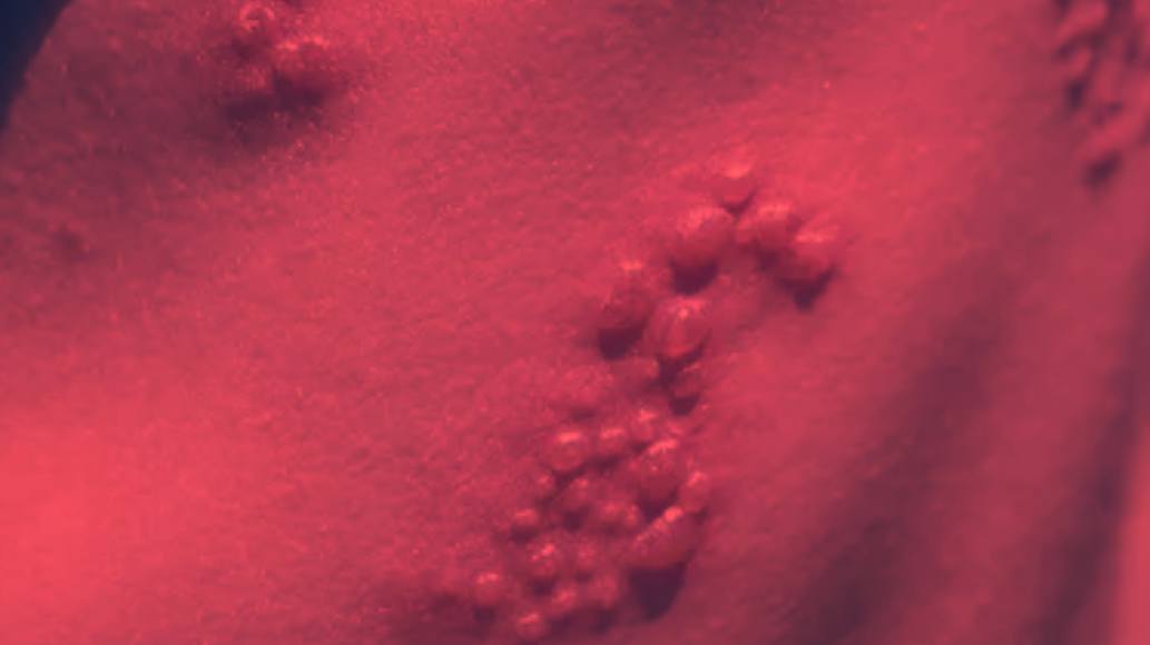 Red Light Therapy for Herpes