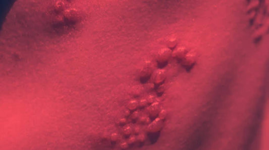 Red Light Therapy for Herpes