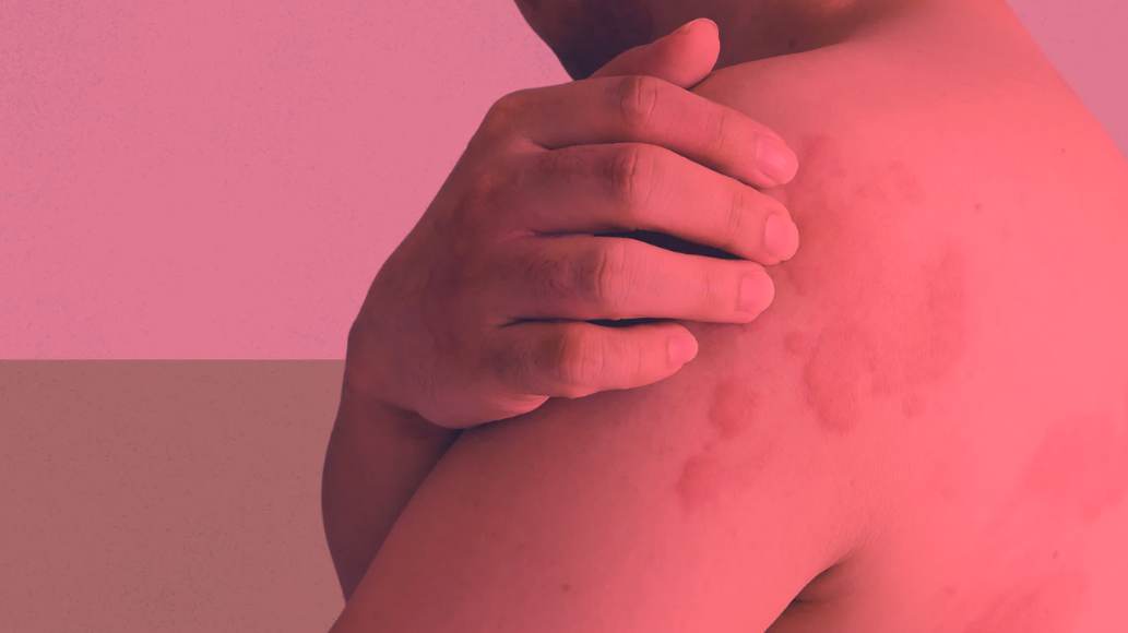 Is Red Light Therapy Good for Hives