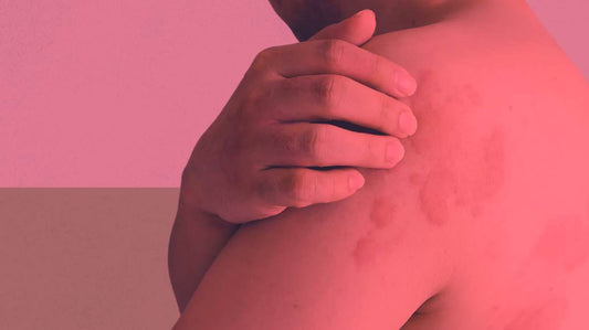 Is Red Light Therapy Good for Hives