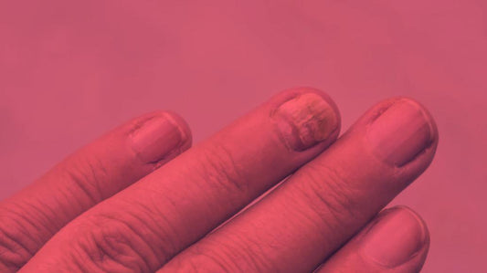 Red Light Therapy for Nail Fungus