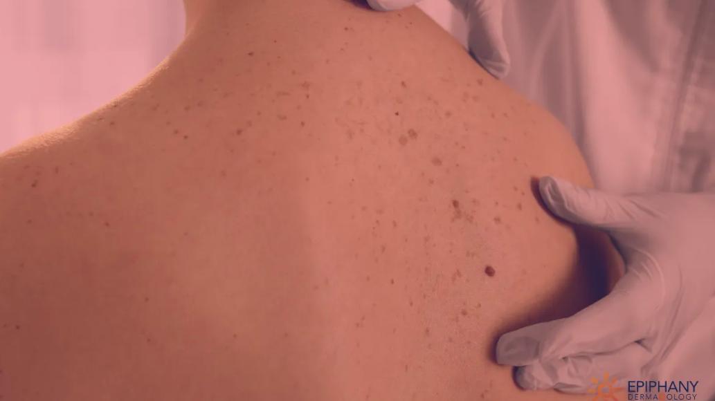 Red Light Therapy for Precancerous