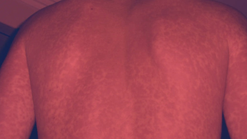 Red Light Therapy for Rash