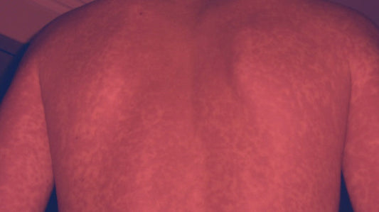 Red Light Therapy for Rash