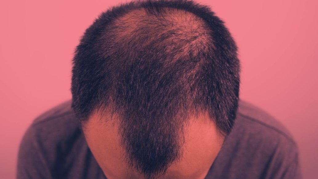 Red Light Therapy for Androgenetic Alopecia