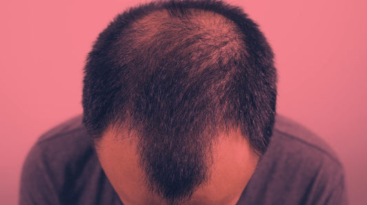 Red Light Therapy for Androgenetic Alopecia