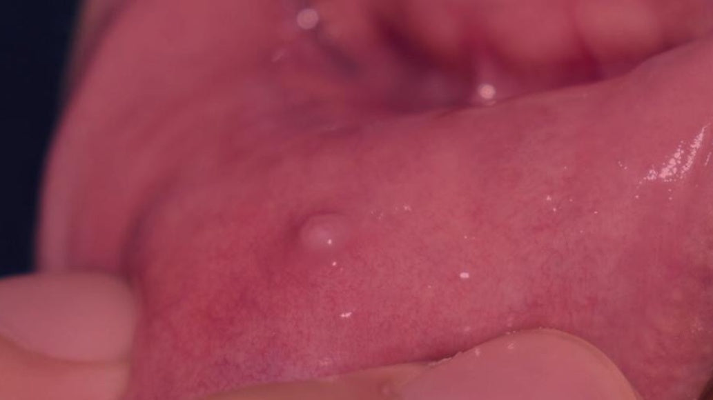 Red Light Therapy for Mucoceles