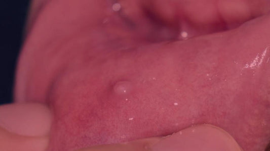 Red Light Therapy for Mucoceles