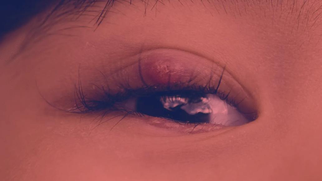 Red Light Therapy for Stye