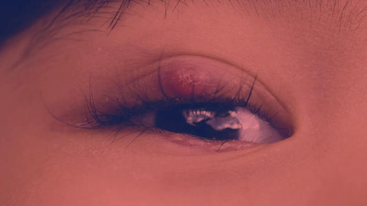 Red Light Therapy for Stye
