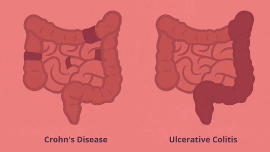 Red Light Therapy for Ulcerative Colitis