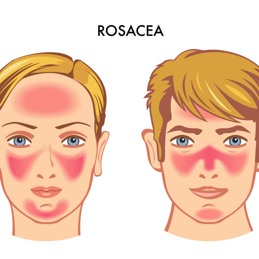 red light therapy for rosacea